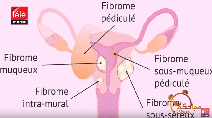 أسباب وأعراض الورم الليفي في الرحم وطرق الوقاية والعلاج مع د مراد يزيد