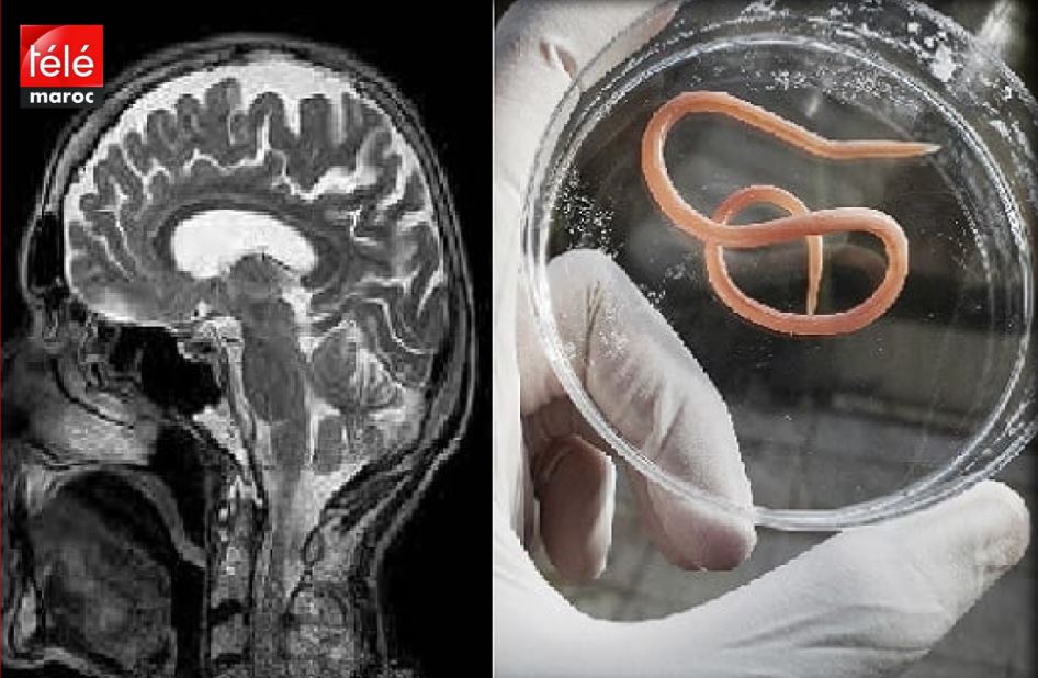 العثور على دودة حية بطول 8 سم في دماغ امرأة أسترالية
