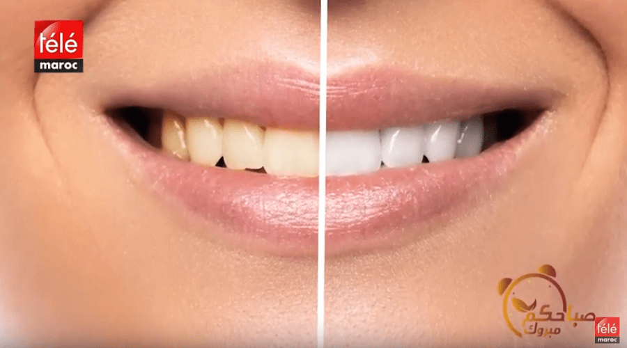 هذه أنواع تبيض الأسنان وطرق العناية بها