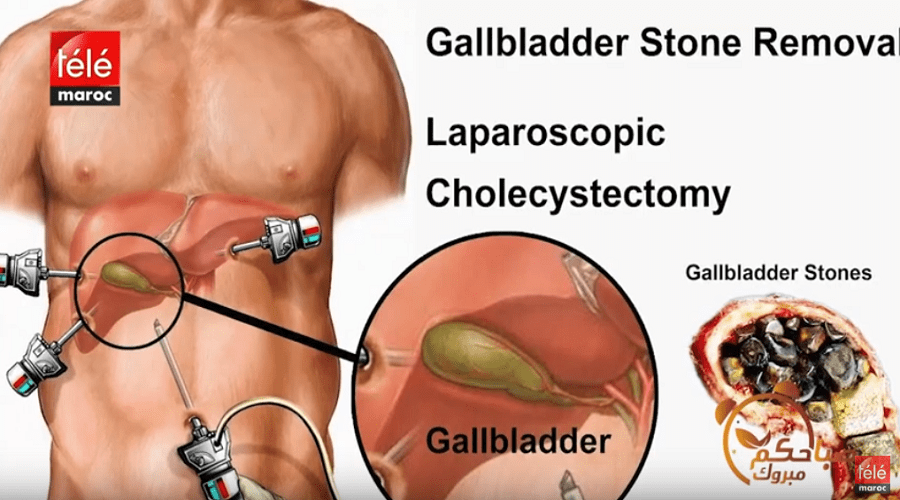 هكذا يتم تشخيص حصى المرارة وهذه طرق علاجه