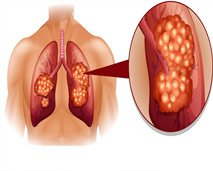 الصحة اليوم:  ما يجب عليك معرفته حول أسباب وأعراض سرطان الرئة