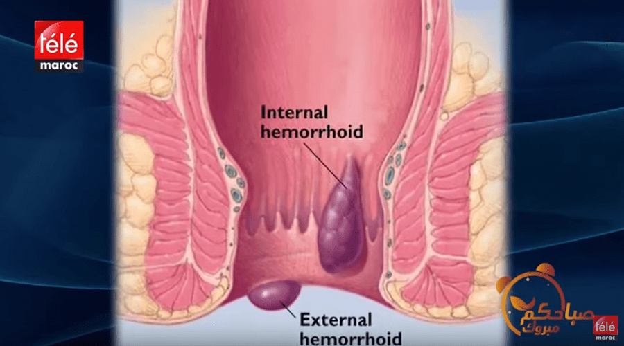 تعرفوا على مسببات البواسير وطرق علاجها